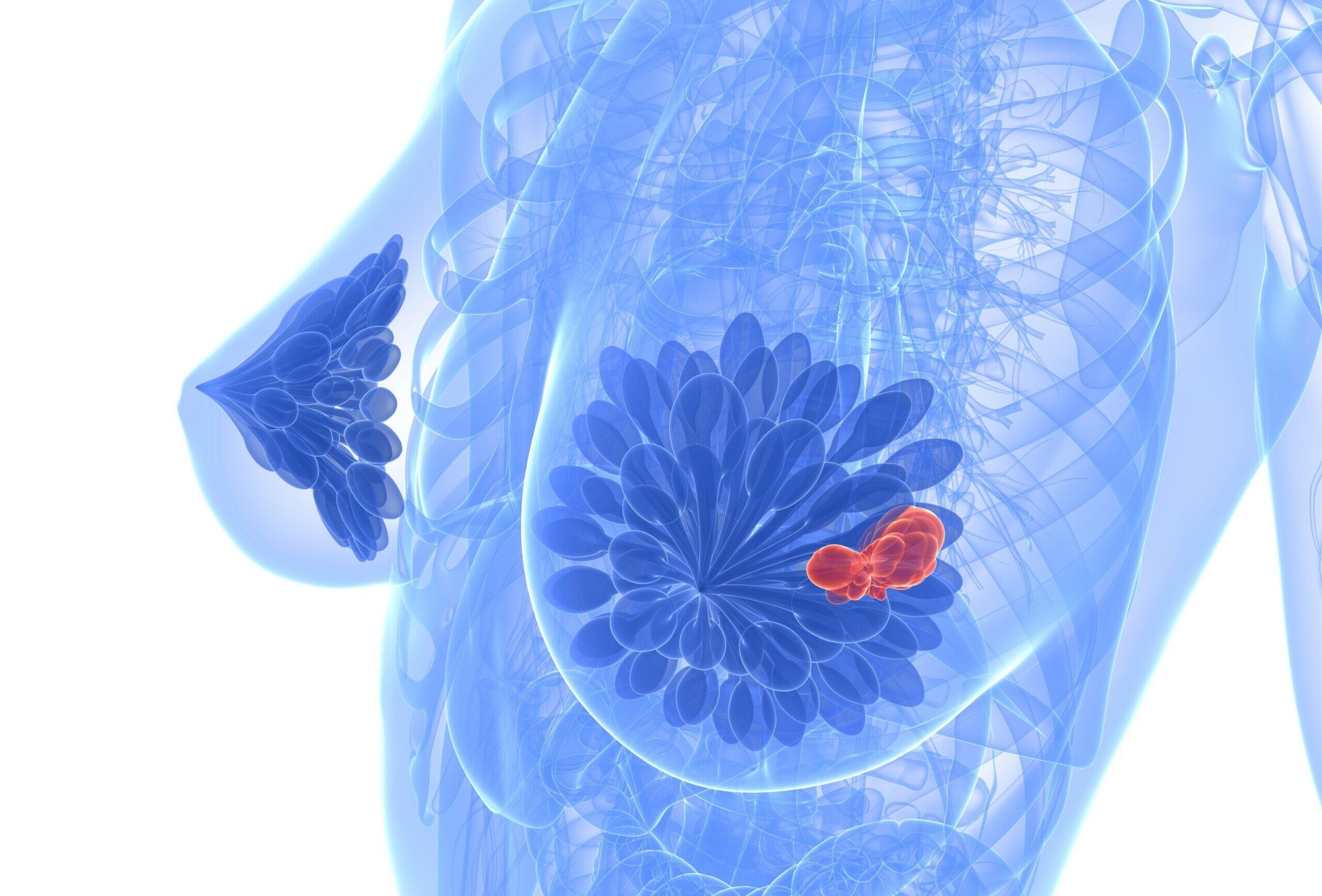 Triple-negativer Brustkrebs (TNBC) – was ist das?