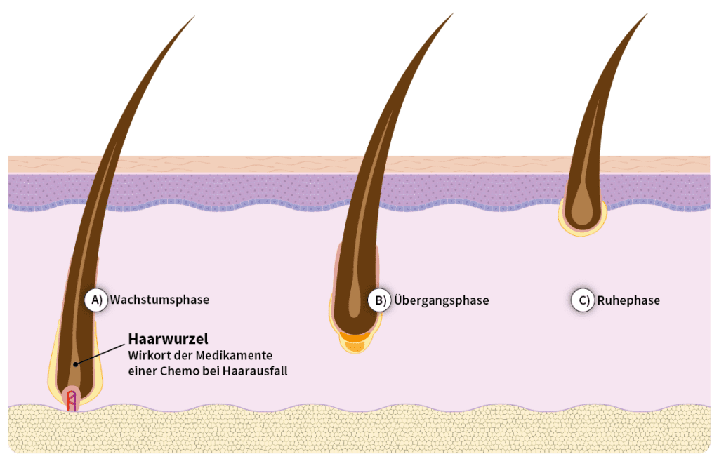 Haarausfall bei Chemotherapie