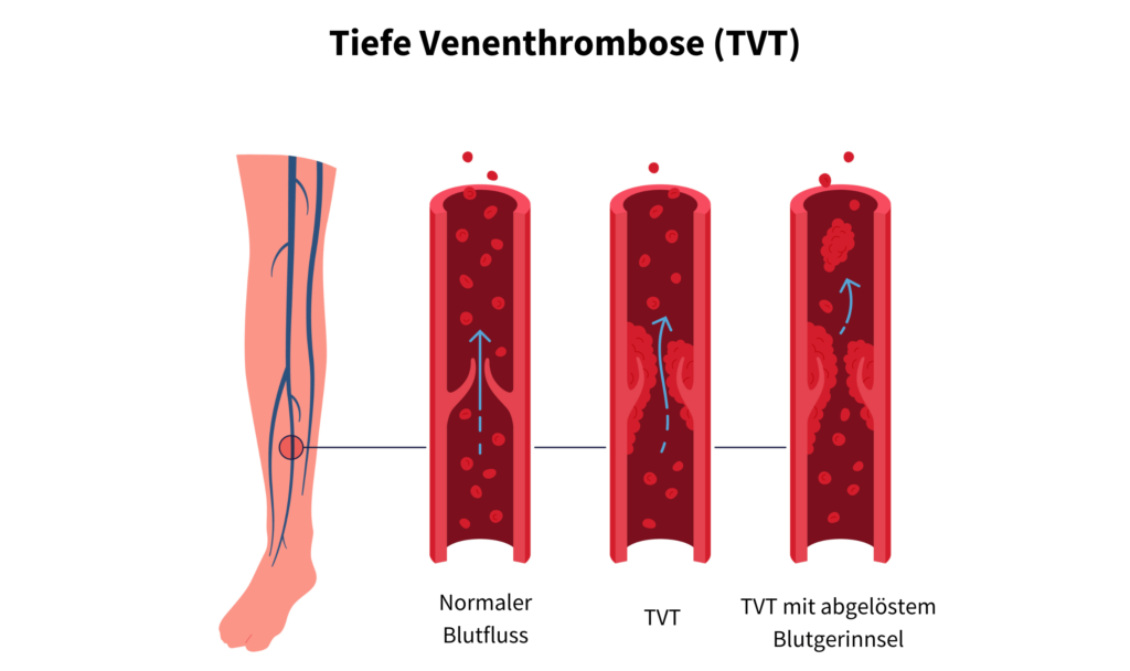 Tiefe Venenthrombose