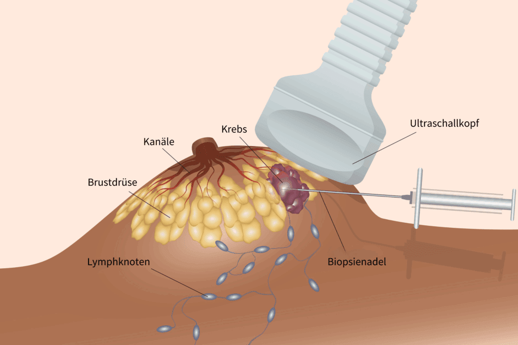 Biopsie bei Brustkrebs
