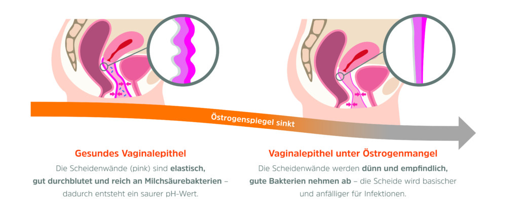 Grafik Scheidentrockenheit