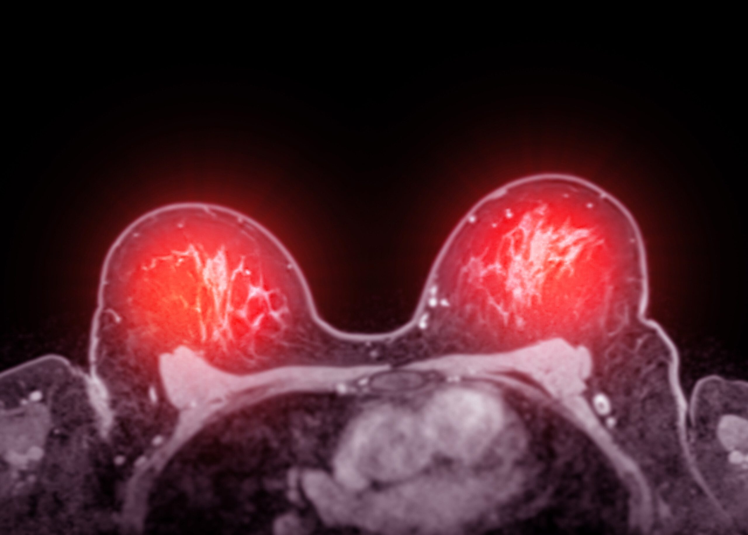 Brust-MRT (Mamma-MRT): Die wichtigsten Fragen und Antworten